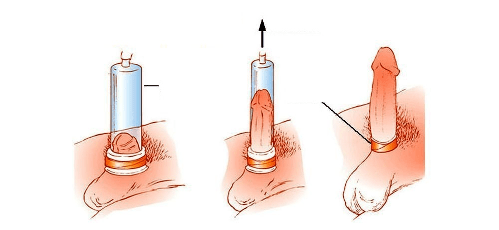 Ecco come funziona una pompa a vuoto per l'ingrandimento del pene