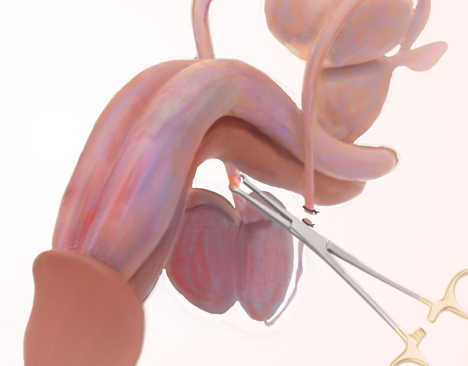Legamentotomia per l'ingrandimento del pene