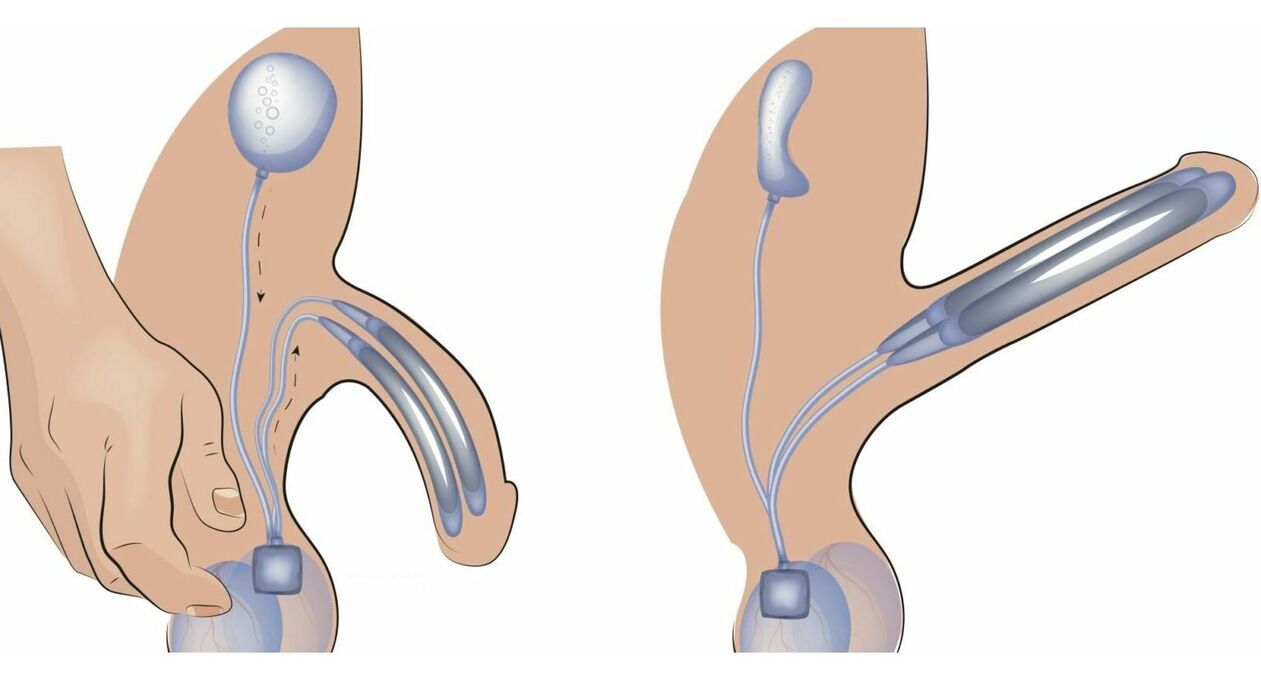 Protesi peniena per l'ingrandimento del pene